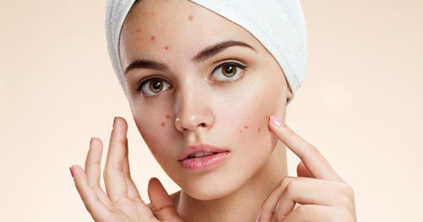 එක රැයකින් කුරුලෑ අඩු කරගන්න ඕනිද? | How to Get Rid of Pimples Fast