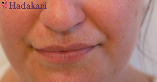 ඔබේ උඩු තොලට දහඩිය දැමීම කරදරයක් ද? | Is sweaty upper lip disturbing you?